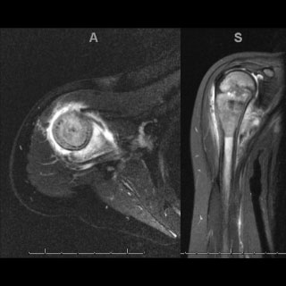 X-ray of limb tumor