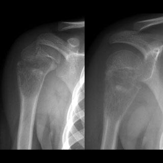 X-ray of upper limb