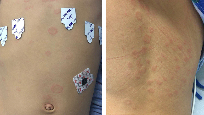 Annular plaques on the torso (L) and back (R) of a patient with MIS-C