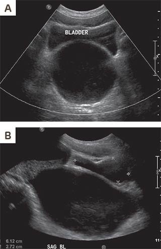bladder ultrasound